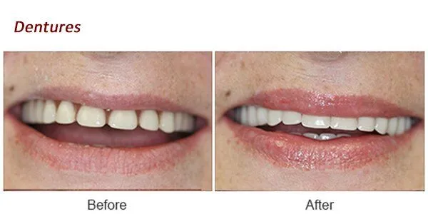 Dentures Before and After