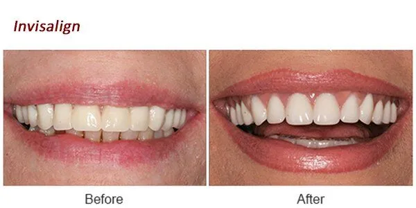 Invisalign Before and After