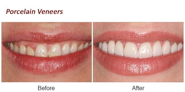 Porcelain Veneers Before and After