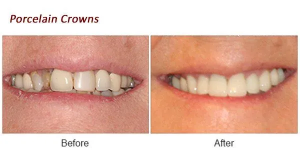 Porcelain Crowns Before and After.porcelain-crowns-before-after-1