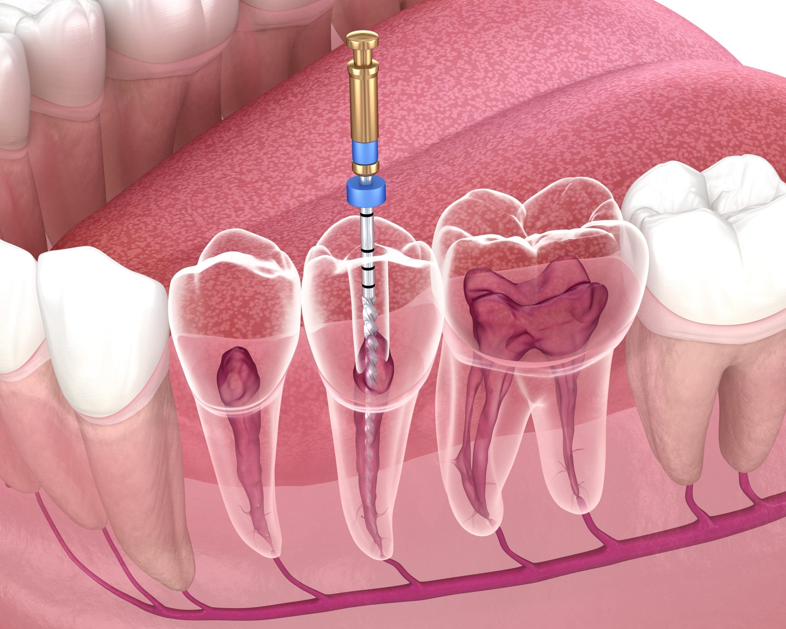 What is Endodontics Understanding the Basics