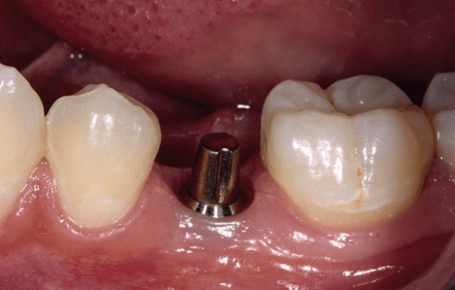 What Is an Implant With Abutment